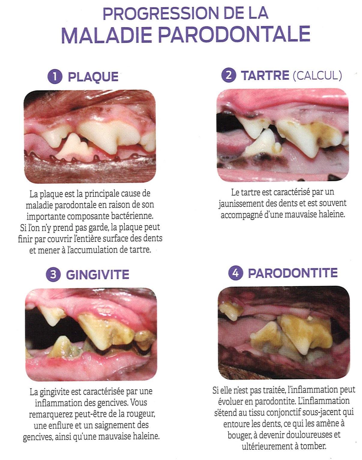 Soins dentaire - progression de la maladie parodontale